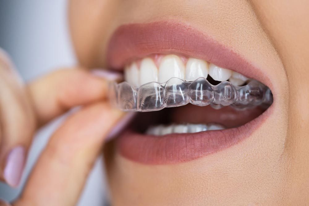Woman applying clear braces into her mouth